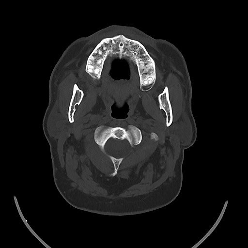 Chronic osteomyelitis - calvarial (severe) (Radiopaedia 69668-79616 Axial bone window 18).jpg