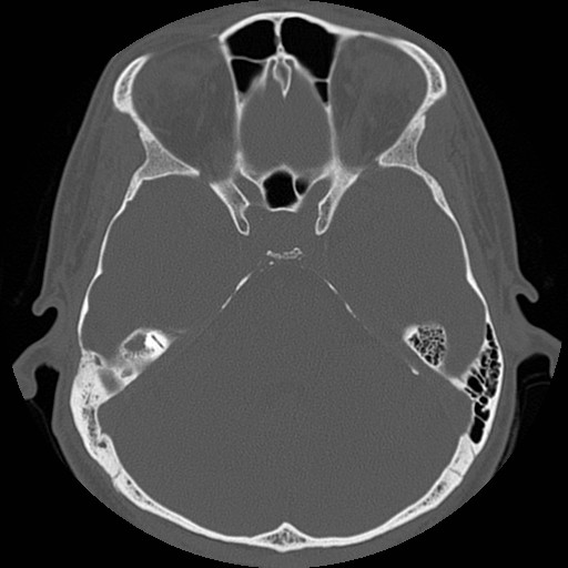 File:Chronic otomastoiditis (Radiopaedia 27138-27309 Axial bone window 48).jpg