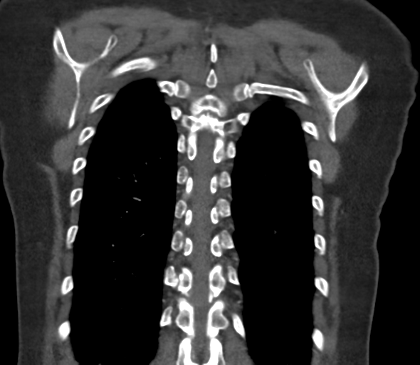 Chronic pulmonary embolus (Radiopaedia 39129-41341 Coronal C+ CTPA 70).png