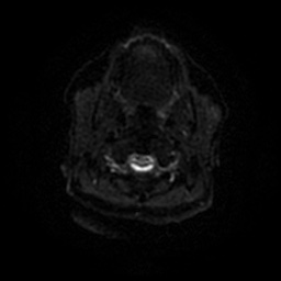 Chronic submandibular sialadenitis (Radiopaedia 61852-69885 Axial DWI 40).jpg