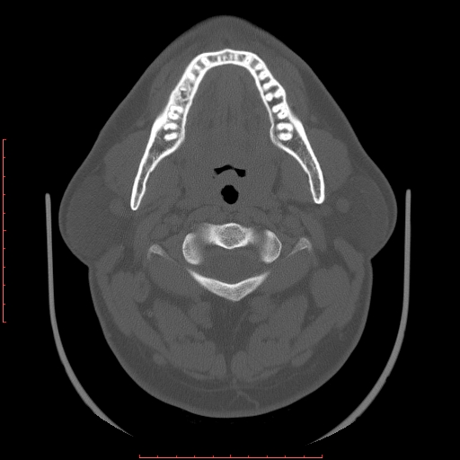 Chronic submandibular sialolithiasis (Radiopaedia 69817-79814 Axial bone window 44).jpg