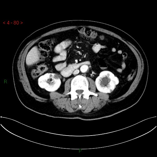 File:Circumaortic left renal vein and doubled left renal arteries (Radiopaedia 52268-58158 B 40).jpg