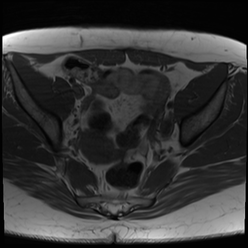 File:Class II Mullerian duct anomaly- unicornuate uterus with rudimentary horn and non-communicating cavity (Radiopaedia 39441-41755 Axial T1 13).jpg