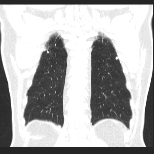 File:Classic complicated silicosis (Radiopaedia 49720-54961 Coronal lung window 52).jpg