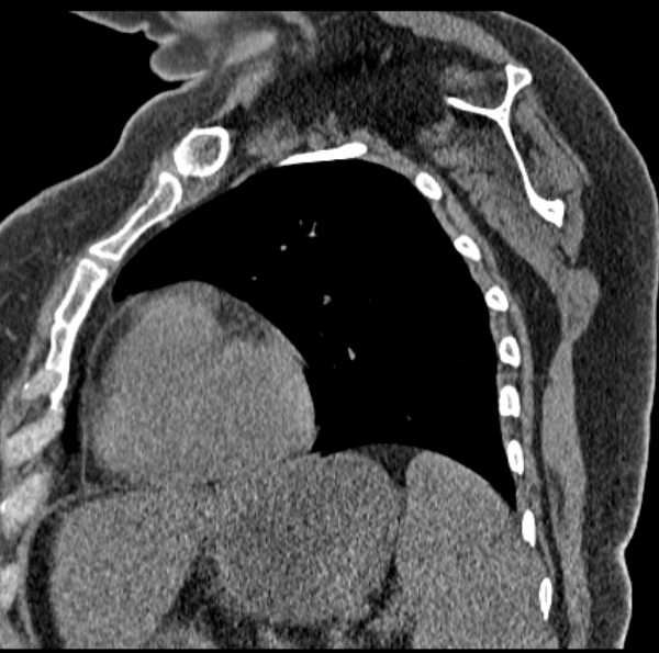 File:Clear cell chondrosarcoma - humerus (Radiopaedia 63104-71612 D 50).jpg