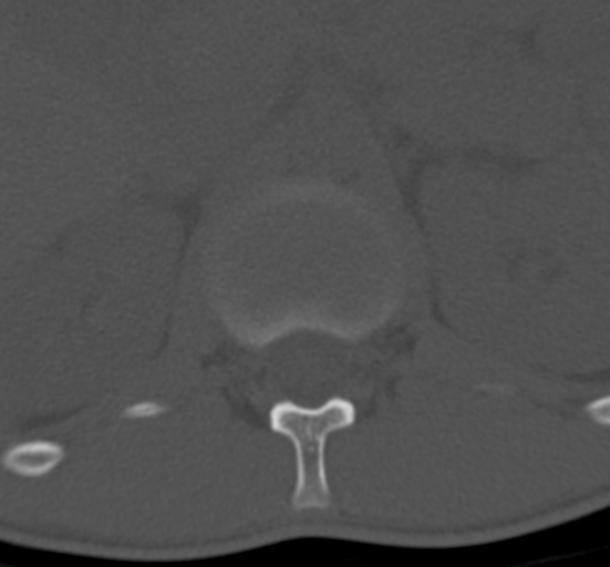Clear cell meningoma - lumbar spine (Radiopaedia 60116-67691 Axial bone window 8).png