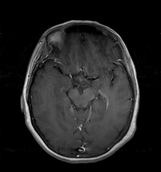 File:Clival meningioma (Radiopaedia 53278-59248 Axial T1 C+ 9).jpg