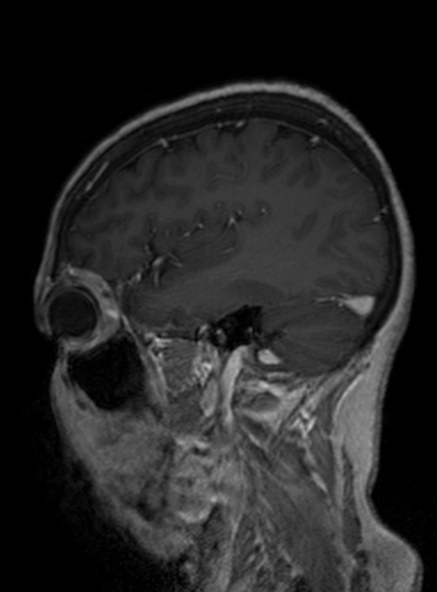 Clival meningioma (Radiopaedia 53278-59248 Sagittal T1 C+ 186).jpg