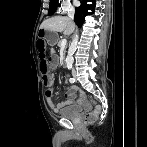 File:Closed loop obstruction due to adhesive band, resulting in small bowel ischemia and resection (Radiopaedia 83835-99023 F 92).jpg
