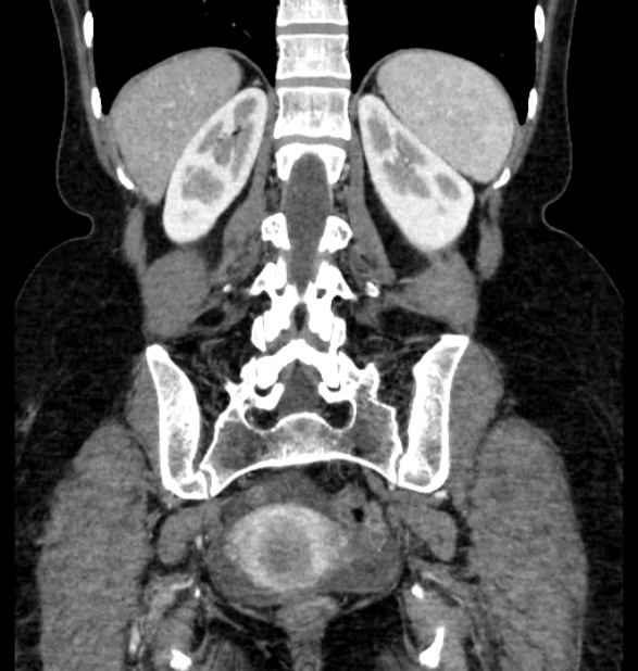 Closed loop small bowel obstruction (Radiopaedia 71211-81508 B 98).jpg