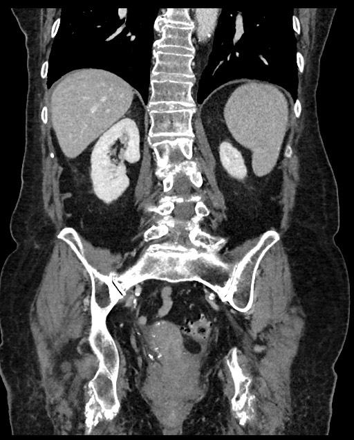 Closed loop small bowel obstruction - adhesions (Radiopaedia 59269-66611 B 87).jpg