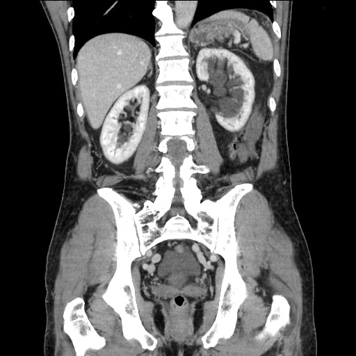 File:Closed loop small bowel obstruction - omental adhesion causing "internal hernia" (Radiopaedia 85129-100682 B 89).jpg