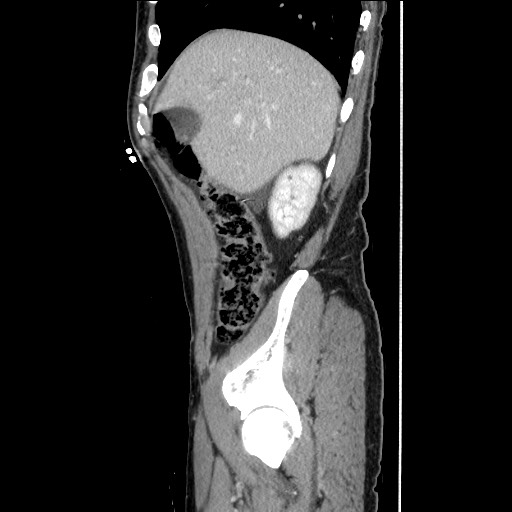File:Closed loop small bowel obstruction - omental adhesion causing "internal hernia" (Radiopaedia 85129-100682 C 48).jpg
