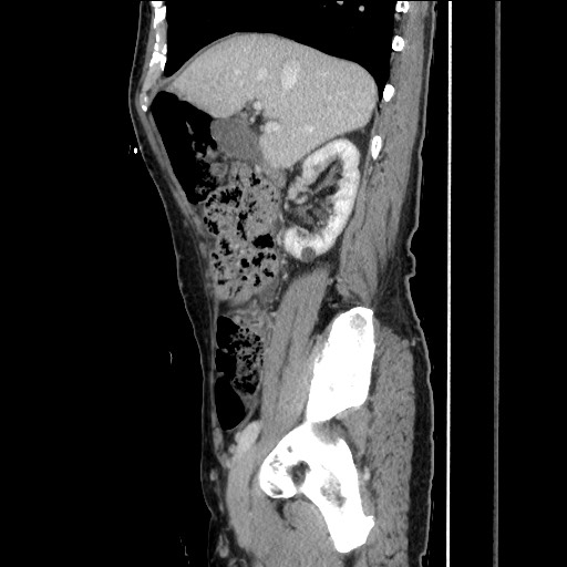 Closed loop small bowel obstruction - omental adhesion causing "internal hernia" (Radiopaedia 85129-100682 C 65).jpg