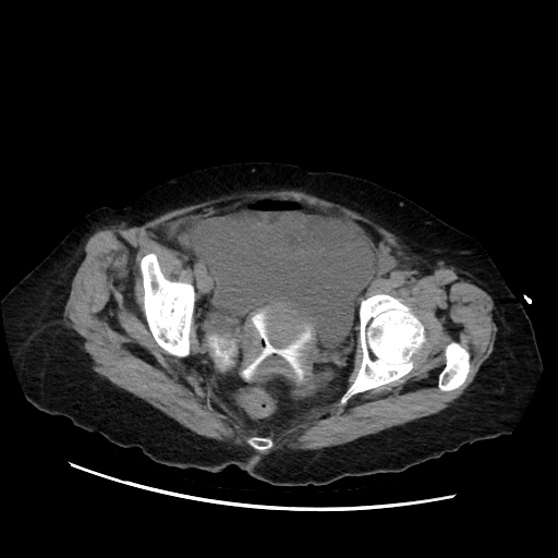 Closed loop small bowel obstruction due to adhesive band, with intramural hemorrhage and ischemia (Radiopaedia 83831-99017 Axial non-contrast 142).jpg