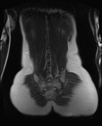 File:Closed loop small bowel obstruction in pregnancy (MRI) (Radiopaedia 87637-104031 Coronal T2 47).jpg