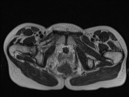 Closed loop small bowel obstruction in pregnancy (MRI) (Radiopaedia 87637-104031 D 41).jpg