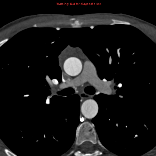 File:Coarctation of the aorta (Radiopaedia 12461-12697 A 180).jpg