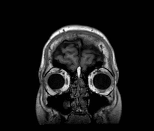 Cochlear incomplete partition type III associated with hypothalamic hamartoma (Radiopaedia 88756-105498 Coronal T1 57).jpg