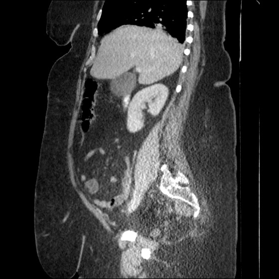 File:Collection due to leak after sleeve gastrectomy (Radiopaedia 55504-61972 C 42).jpg