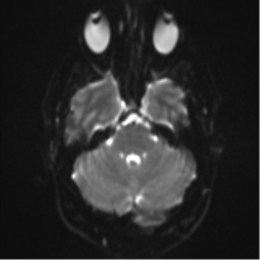 File:Colloid cyst (Radiopaedia 44510-48181 Axial DWI 8).png