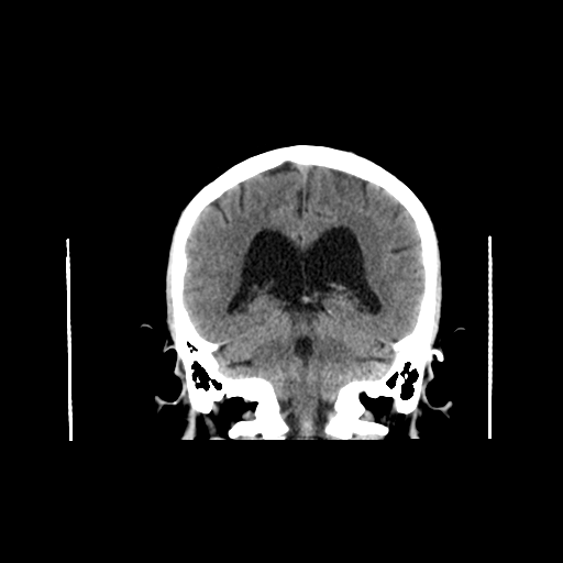 File:Colloid cyst of the third ventricle (Radiopaedia 86571-102661 Axial non-contrast 1).png