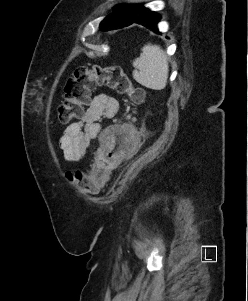 Colon adenocarcinoma (Radiopaedia 59374-66735 C 14).jpg