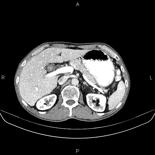 Colon adenocarcinoma - hepatic flexure (Radiopaedia 85635-101395 A 26).jpg