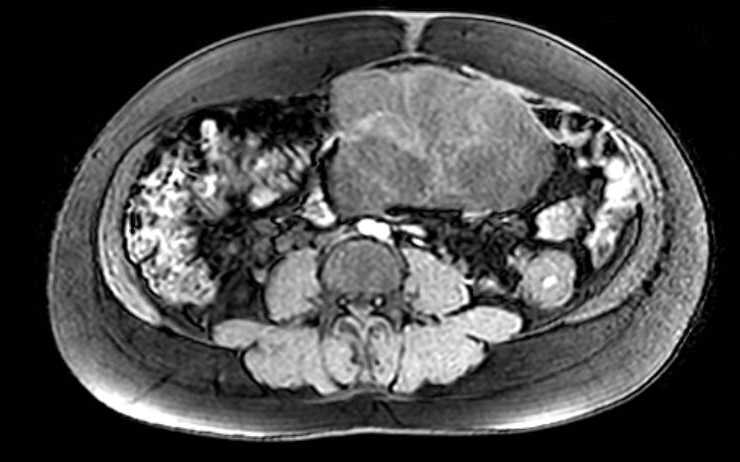 File:Colon adenocarcinoma with Krukenberg tumors, advanced pregnancy (Radiopaedia 67279-76645 A 40).jpg
