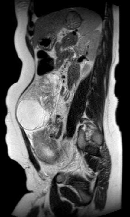 Colon adenocarcinoma with Krukenberg tumors, advanced pregnancy (Radiopaedia 67279-76645 Sagittal T2 20).jpg