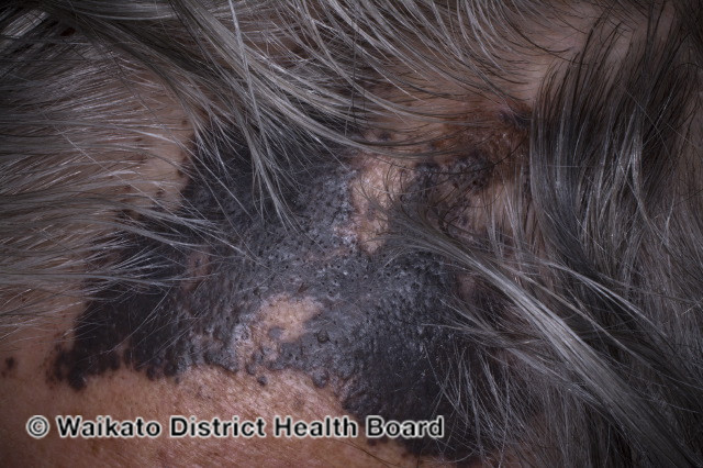 File:Cutaneous melanoma mestastases (DermNet NZ metastatic-melanoma-008).jpg