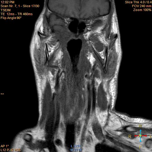 File:Nasopharyngeal carcinoma (Radiopaedia 22375-22403 Coronal T1 8).jpg