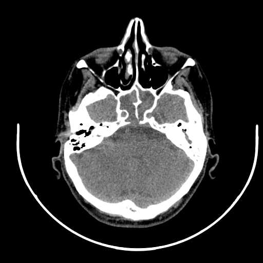 File:Nasopharyngeal carcinoma - infiltrating the clivus (Radiopaedia 62583-70875 Axial non-contrast 8).jpg