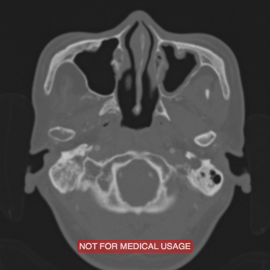 Nasopharyngeal carcinoma recurrence - skull base destruction (Radiopaedia 29107-29490 Axial bone window 94).jpg