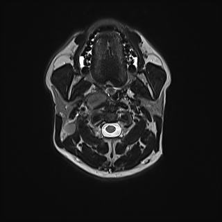 Nasopharyngeal carcinoma with perineural spread (Radiopaedia 55030-61380 Axial T2 38).jpg