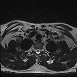 Nasopharyngeal carcinoma with perineural spread (Radiopaedia 55030-61380 Axial T2 84).jpg