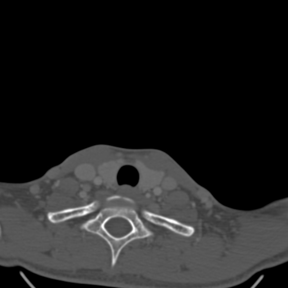 File:Nasopharyngeal carcinoma with skull base invasion (Radiopaedia 53415-59705 Axial bone window 181).jpg