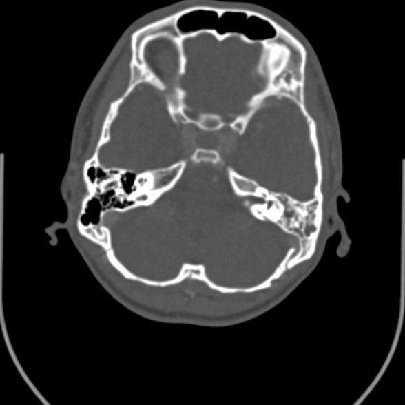 Nasopharyngeal carcinoma with skull base invasion (Radiopaedia 53415-59705 Axial bone window 8).jpg