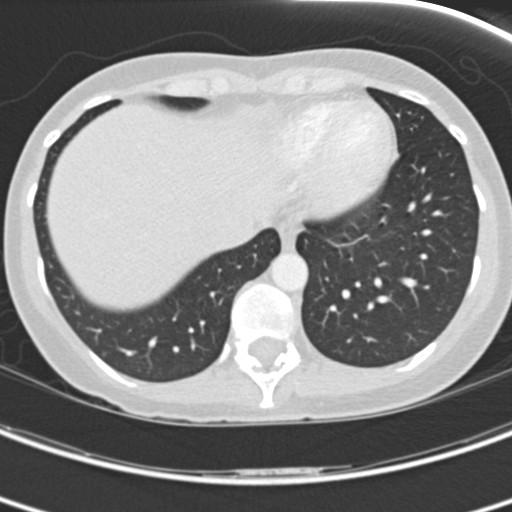 Necrobiotic pulmonary nodules - Crohn disease (Radiopaedia 20723-20631 Axial lung window 113).jpg