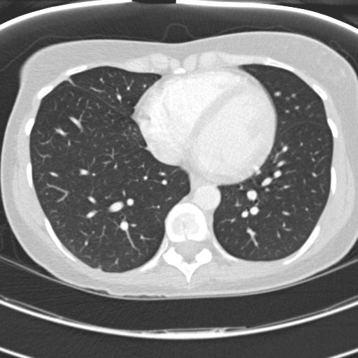 File:Necrobiotic pulmonary nodules - Crohn disease (Radiopaedia 20723-20631 Axial lung window 98).jpg
