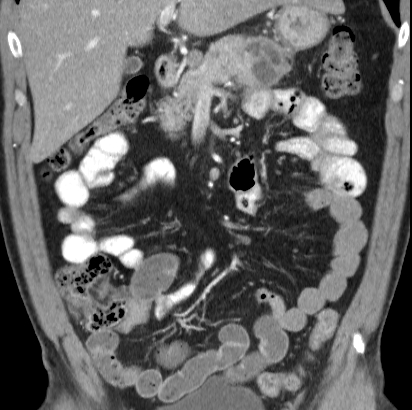 File:Necrotizing pancreatitis with acute necrotic collection (Radiopaedia 14470-14417 C 13).jpg