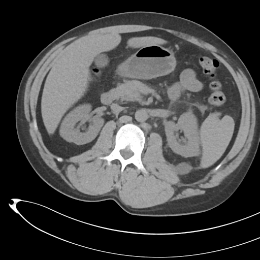 File:Necrotizing pancreatitis with acute necrotic collections (Radiopaedia 38829-41012 Axial non-contrast 34).png