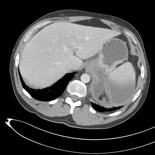File:Necrotizing pancreatitis with acute necrotic collections (Radiopaedia 38829-41012 B 16).png