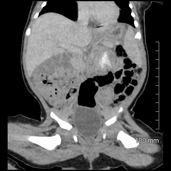 File:Neonatal neuroblastoma (Radiopaedia 56651-63438 Coronal non-contrast 26).jpg