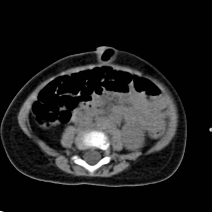 Neuroblastoma with skull metastases (Radiopaedia 30326-30960 Axial non-contrast 38).jpg