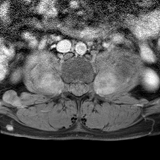 File:Neurofibromatosis type 1- extensive spinal involvement and Christmas tree sign (Radiopaedia 60610-68332 Axial T1 C+ fat sat 66).jpg
