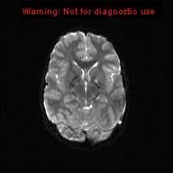 File:Neurofibromatosis type 1 with optic nerve glioma (Radiopaedia 16288-15965 Axial DWI 13).jpg