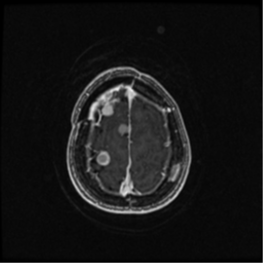 Neurofibromatosis type 2 (Radiopaedia 45229-49244 Axial T1 C+ 100).png