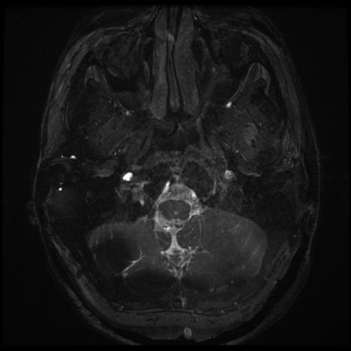 Neurofibromatosis type 2 - bilateral acoustic neuromata (Radiopaedia 40060-42566 Axial FIESTA 3).png