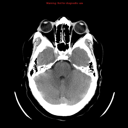 File:Neuroglial cyst (Radiopaedia 10713-11185 Axial non-contrast 23).jpg
